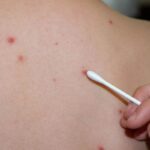 Allarme morbillo a New York: scatta lo stato di emergenza. Oltre 100 contagi nello Stato