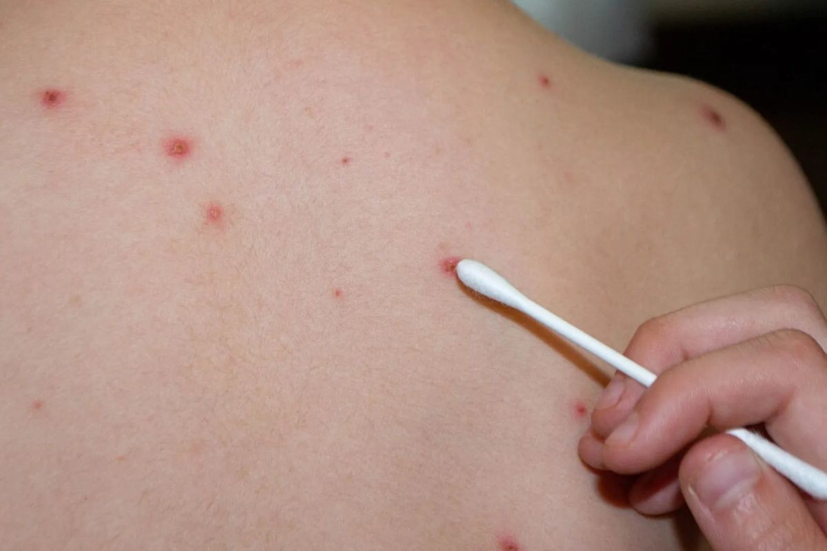 Allarme morbillo a New York: scatta lo stato di emergenza. Oltre 100 contagi nello Stato